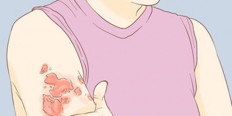 Tratando uma infecção por fungos na pele