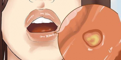 Curando uma inflamação na boca