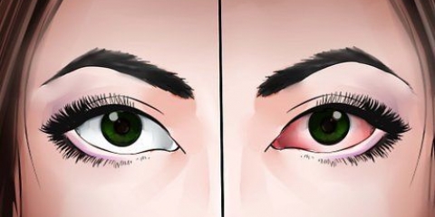 Tratando uma infecção ocular naturalmente