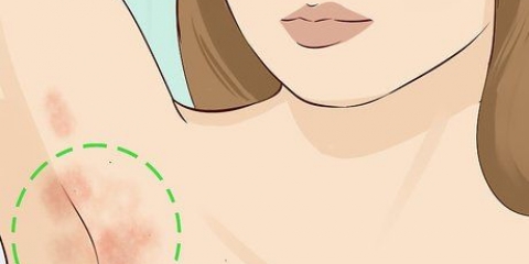 Tratando uma infecção fúngica da pele