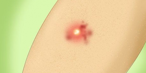 Tratamento de uma infecção estafilocócica
