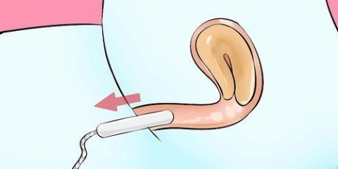 Remover um tampão