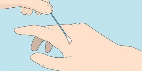 Congelando uma verruga com nitrogênio líquido