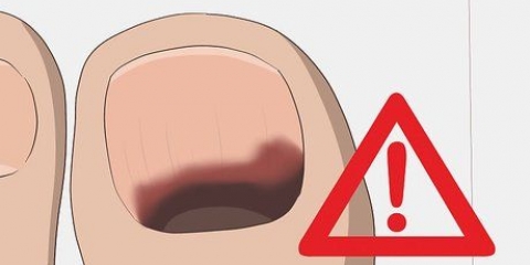 Como tratar uma unha preta