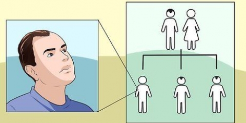 Tratamento da queda de cabelo em homens