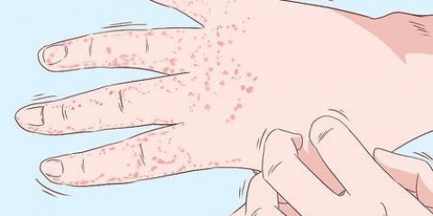 Tratamento de eczema nas mãos