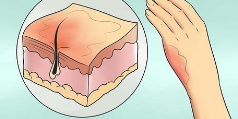 Tratamento de queimaduras leves