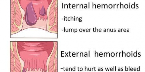 Como se livrar das hemorroidas naturalmente