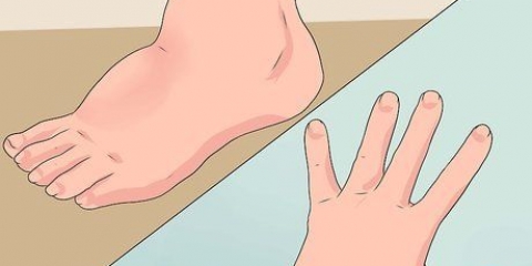 Livre-se do edema naturalmente
