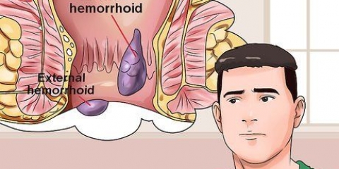 Como curar hemorróidas dolorosas