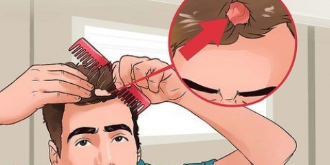 Como tratar a micose no couro cabeludo