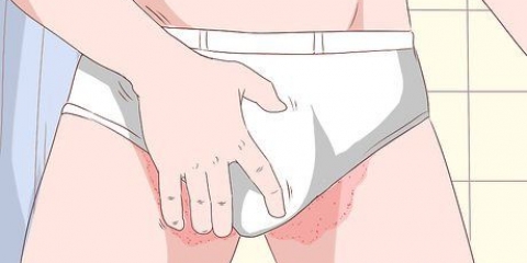 Tratando tinea cruris com sudocrem
