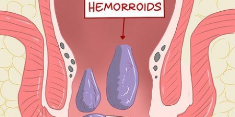 Usando hamamélis para tratar hemorroidas