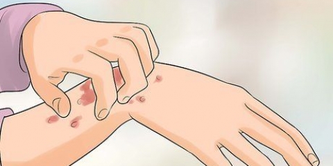 Reconhecendo a erupção do hiv