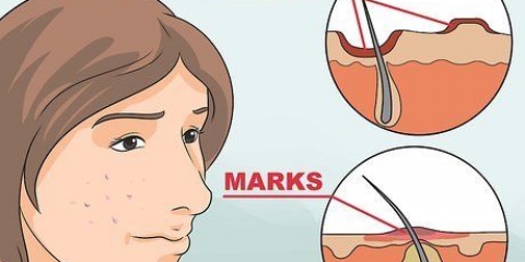 Livre-se das manchas vermelhas da acne