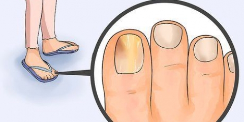 Livre-se das unhas fúngicas