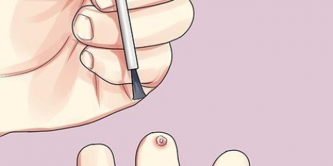 Livre-se das verrugas nas mãos