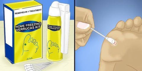 Remover verrugas nos pés
