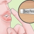 Trate rapidamente a acne ao redor dos lábios