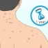 Livre-se das cicatrizes de acne nas costas