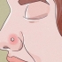 Tratando um piercing no nariz inflamado