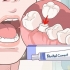 Reparando uma coroa dentária perdida