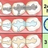 Cuidar de uma obturação em um dente ou molar