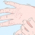 Tratamento de eczema nas mãos