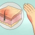 Tratamento de queimaduras leves