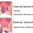 Como se livrar das hemorroidas naturalmente