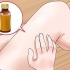 Tratamento da micose: pode naturalmente?