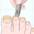 Tratamento de unhas fúngicas