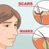 Livre-se das manchas vermelhas da acne