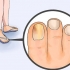 Livre-se das unhas fúngicas
