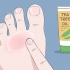 Curar o eczema do nadador: pode ser feito naturalmente?